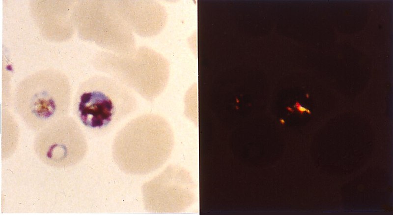 File:Birefringence of malaria pigment.jpg