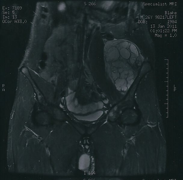 File:Mrichondrosarcoma.jpg