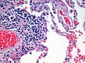 H&E (haematoxylin and eosin) stained lung tissue sample from an end-stage emphysema patient. RBCs are red, nuclei are blue-purple, other cellular and extracellular material is pink, and air spaces are white.