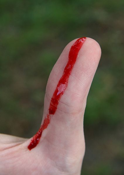 Файл:Bleeding wound on thumb.jpg