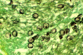 Pneumocystis jirovecii