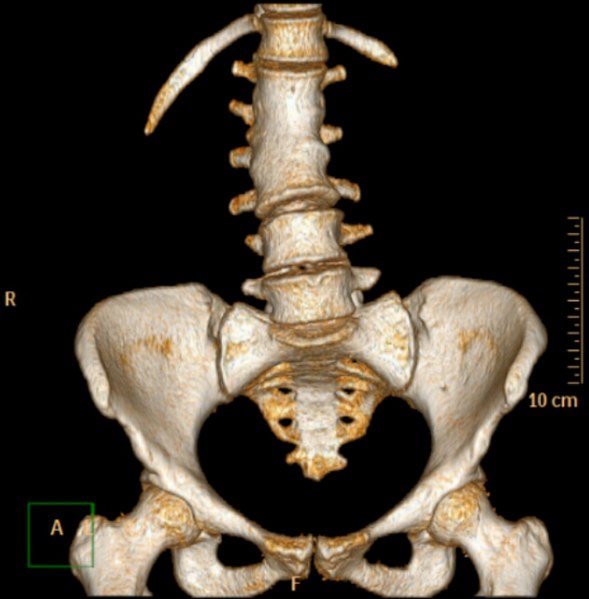 File:Blockwirbel CT VR frontal.jpg