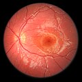 Fundoscopy, left eye of a 5-year-old boy with HJMD