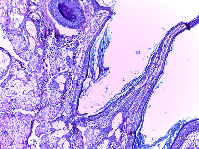 File:Teratoma Ovary 10x.jpg