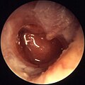 Otitis media chronica mesotympanalis