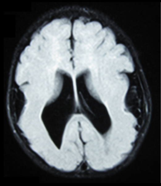 File:Lissencephaly.png