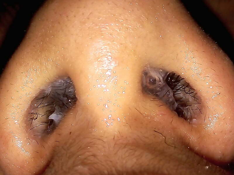 File:Rhinorrhea nasal congestion.jpg