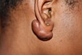 Earlobe keloid