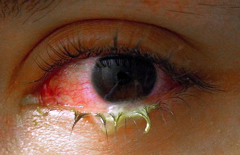 File:Swollen eye with conjunctivitis.jpg