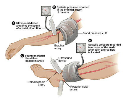 ABI testing is used by vascular surgeons in the diagnosis of PAD. The blood pressure in the arm and leg are compared as a ratio.