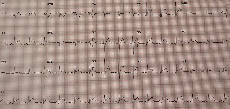 File:PericarditisMyocarditis.jpg