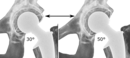 Acetabular inclination is normally between 30 and 50°.[91] A larger angle increases the risk of dislocation.[16]