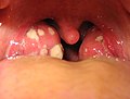 Acute tonsillitis