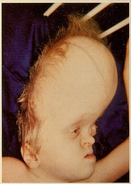 File:Kleeblattschadel Syndrome 3.jpg