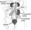 A kidney transplant of the type that Woodruff pioneered.