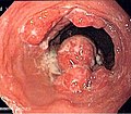 Endoscopic image of an esophageal adenocarcinoma