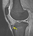 MBq Osgood-Schlatter