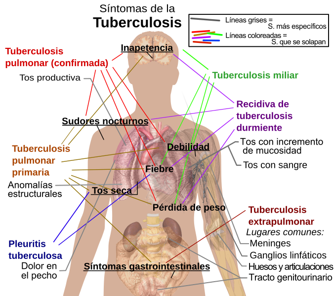 Archivo:Tuberculosis symptoms-es.svg