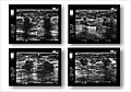 Breastcancer in ultrasound