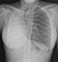 Chest X-ray showing pulmonary hypoplasia