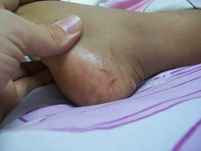 Файл:Snake Bite injury.jpg