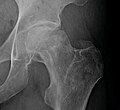 Radiografía de una osteonecrosis de la cabeza femoral izquierda. Hombre de 45 años de edad con SIDA.