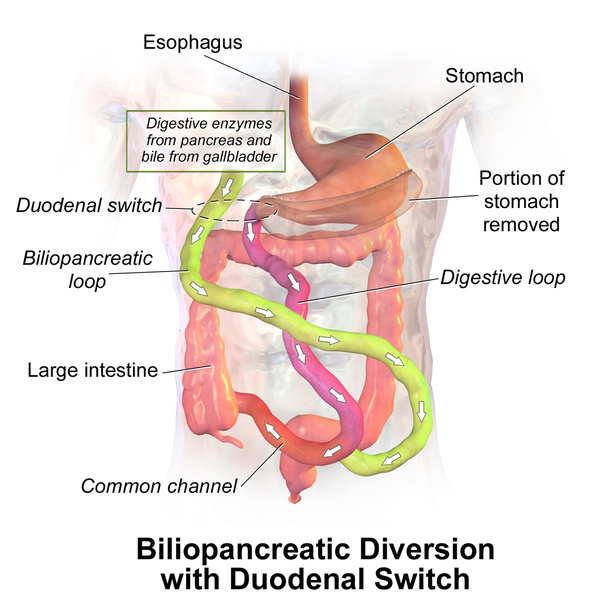 File:Biliopancreatic Diversion.png