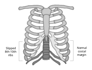 Slipping Rib Syndrome Example