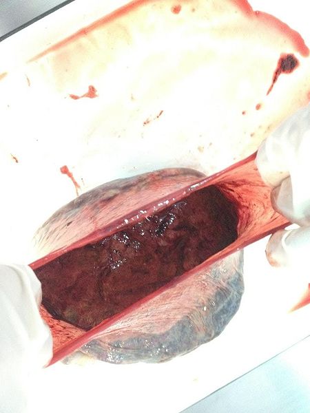 File:Human Placenta after childbirth.jpg