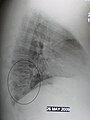 A lateral CXR showing right lower lobe pneumonia