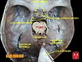 Internal carotid artery