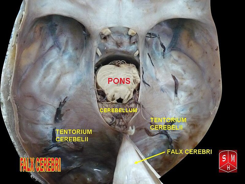 File:Falx cerebri.jpg