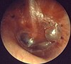 Acute otitis media, myringitis bullosa