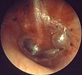 Otitis media acuta - Myringitis bullosa