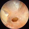 Otitis media chronica mesotympanalis