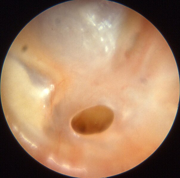 File:Otitis chron mesotymp 4.jpg