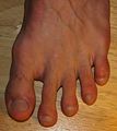 Toes Hallux