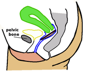 Disposable menstrual cup in the vagina