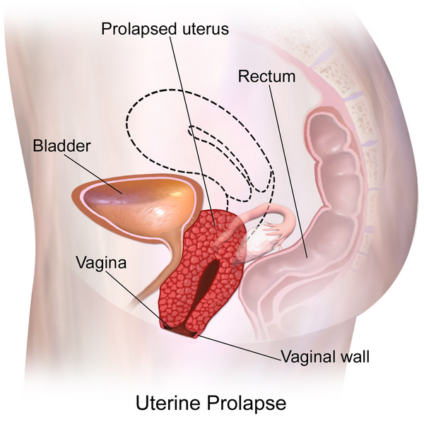 File:Uterine Prolapse.png