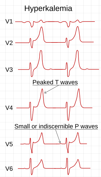 File:ECG in hyperkalemia.svg