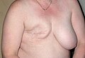 Mastectomy patient