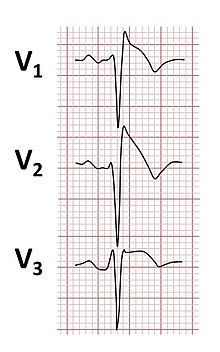 Brugada syndrome ECGs.jpg