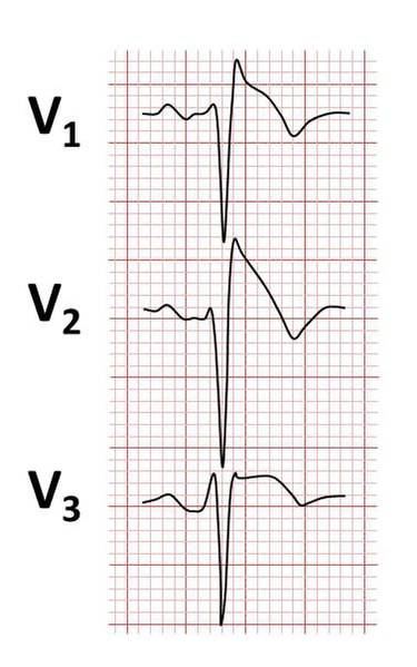 File:Brugada syndrome ECGs.jpg