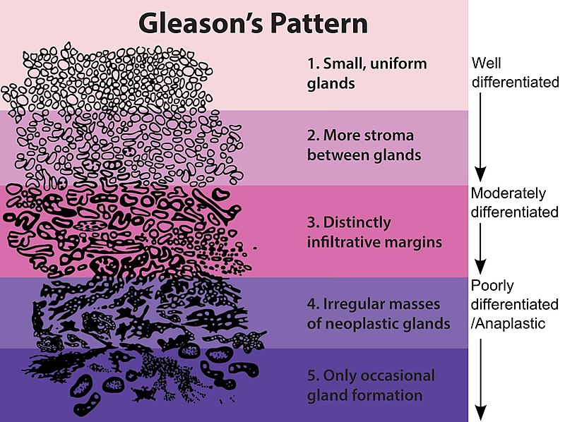 File:Gleasonscore.jpg