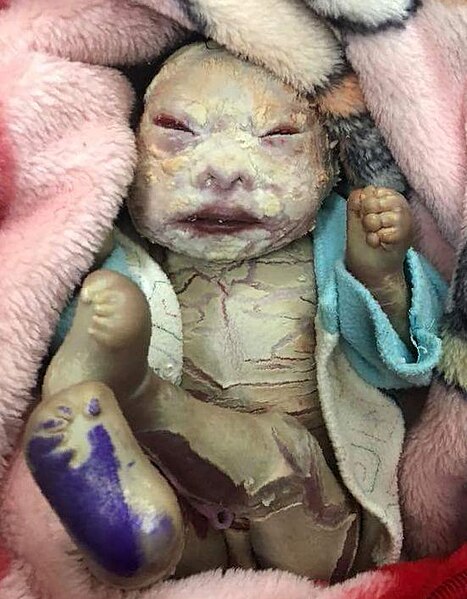 Файл:Harlequin ichtyosis.jpg