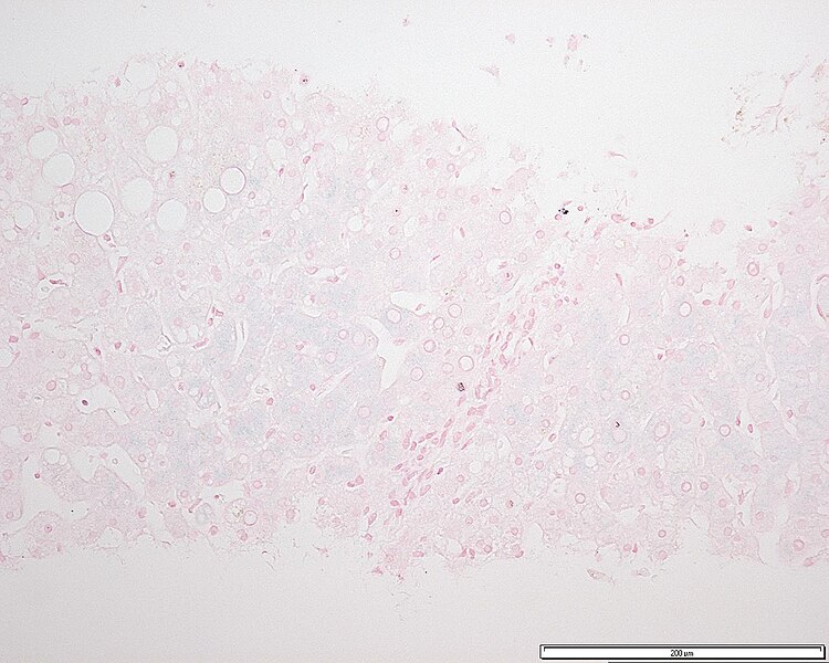 Archivo:Hemochromatosis liver section.JPG