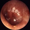 Myringitis bullosa in influenza