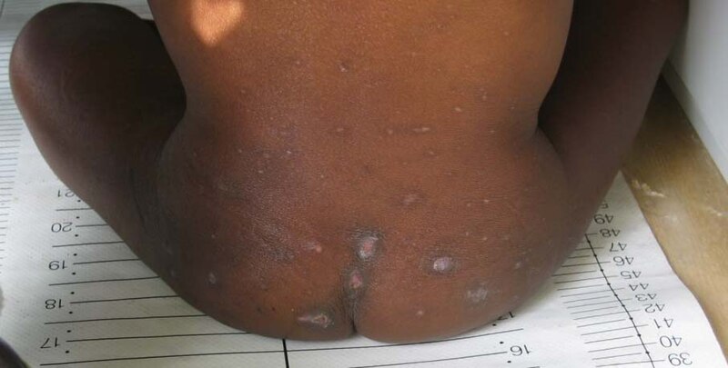 File:Kwashiorkor dermatosis.jpg