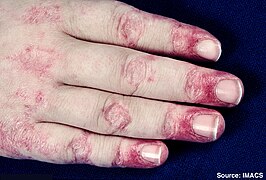 Gottron's papules in severe case of juvenile dermatomyositis