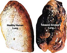 Pale smooth lung contrasted with stained and crumpled lung